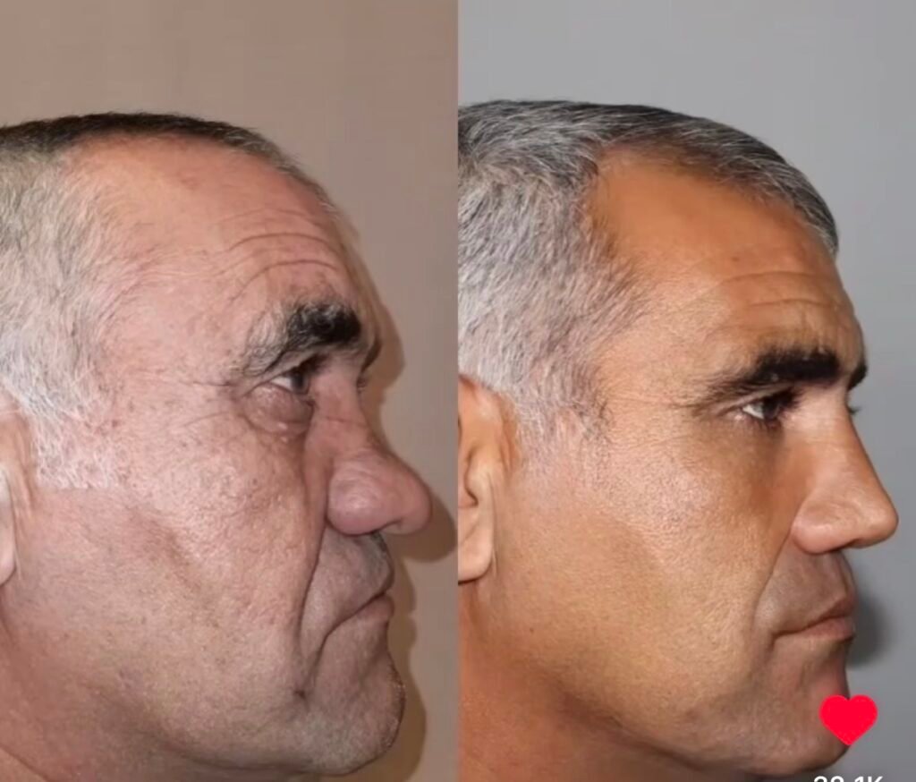 A masterpiece done by Iranian Cosmetic Surgeons in Tehran Right Side