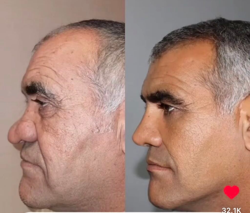 A masterpiece done by Iranian Cosmetic Surgeons in Tehran Left Side